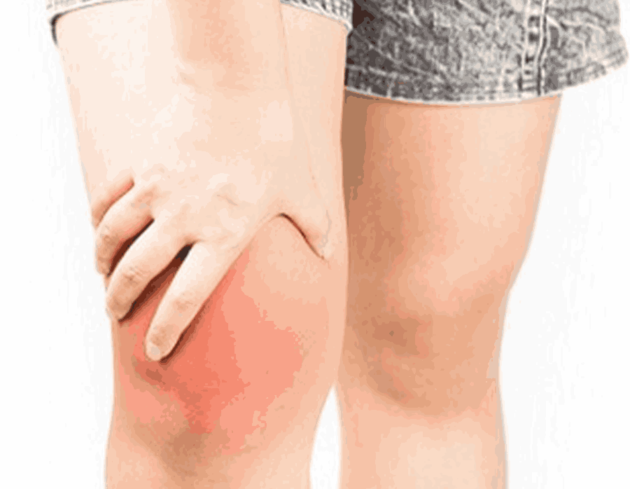 Managing Knee Joint Inflammation: Causes, Symptoms, and Solutions